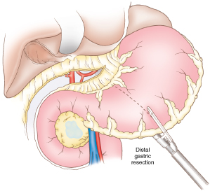 Thoracic_28-2a